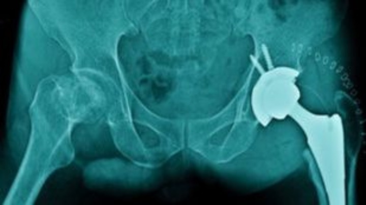 Τα κατάγματα ισχίου λόγω οστεοπόρωσης σχεδόν θα διπλασιασθούν έως το 2050
